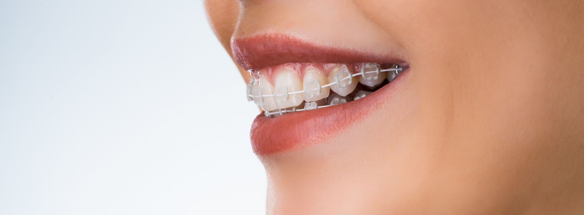 Ortodonti/Diş Teli